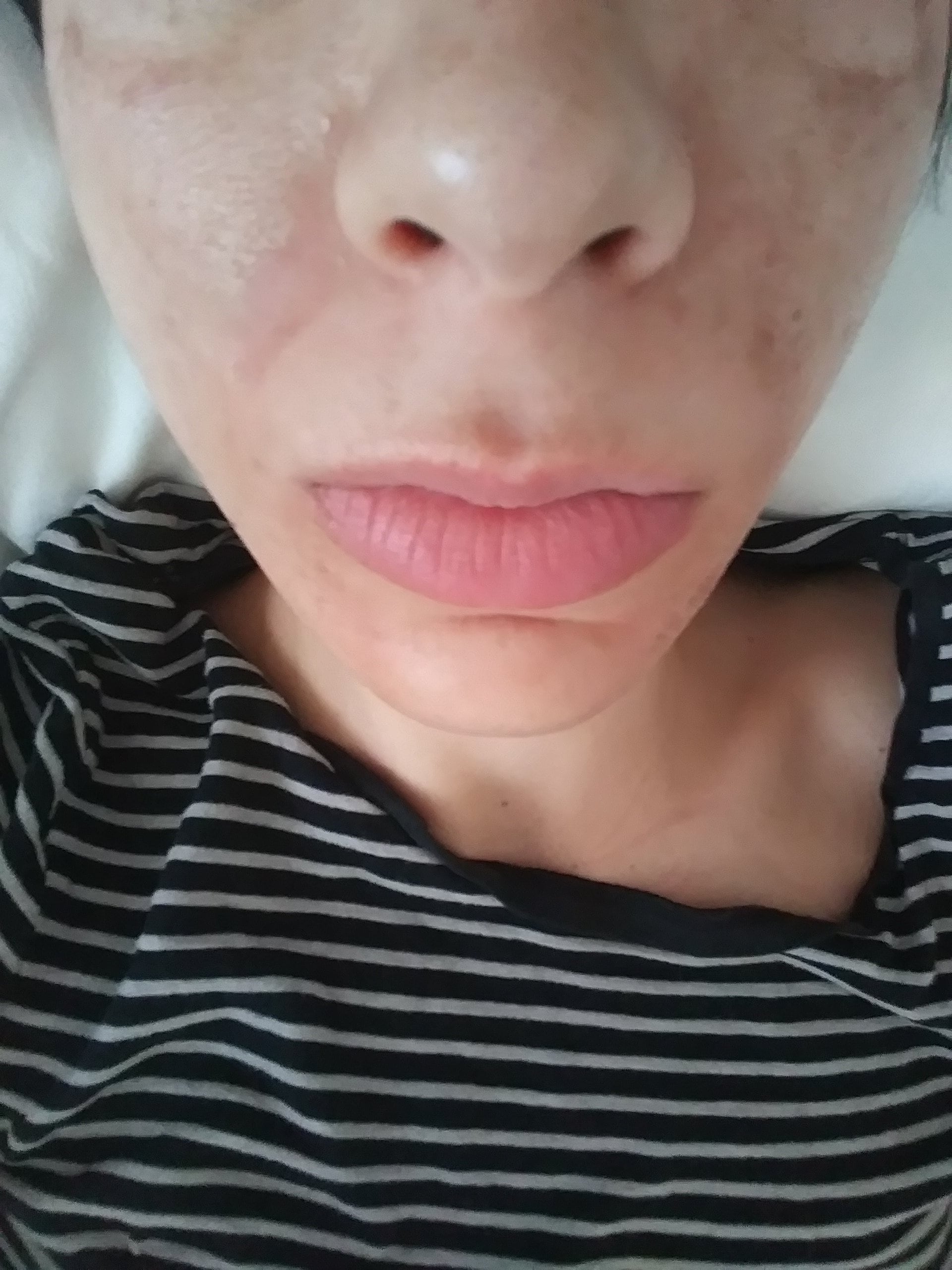 Vegan Lactic Acid Home Peel acne melasma hyperpigmentation over 5000 sold! 4 Strengths 3 Sizes! (25,50,70,88)%